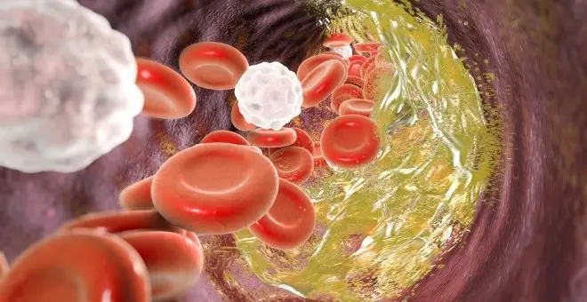 Estudio revela cambios en presión arterial y colesterol en personas con obesidad